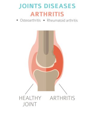 Eklem hastalıkları. Artrit belirtileri, tedavisi Icon set. Tıbbi Infographic tasarım. Vektör çizim