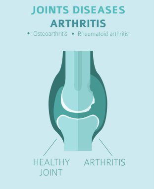 Eklem hastalıkları. Artrit belirtileri, tedavisi Icon set. Tıbbi Infographic tasarım. Vektör çizim