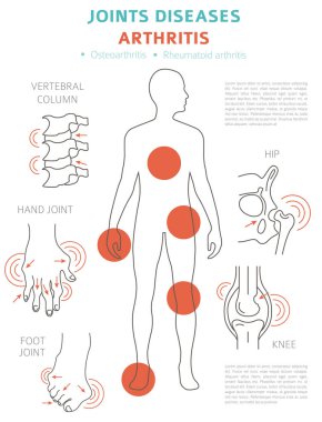 Eklem hastalıkları. Artrit belirtileri, tedavisi Icon set. Tıbbi Infographic tasarım. Vektör çizim