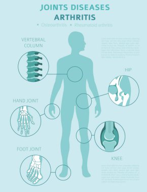 Eklem hastalıkları. Artrit belirtileri, tedavisi Icon set. Tıbbi Infographic tasarım. Vektör çizim
