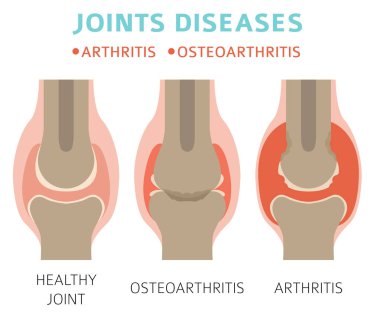 Eklem hastalıkları. Artrit, osteoartrit belirtileri, tedavisi Icon set. Tıbbi Infographic tasarım. Vektör çizim