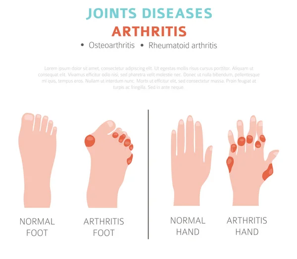 Enfermedades Articulares Síntomas Artritis Conjunto Iconos Tratamiento Diseño Infografía Médica — Vector de stock