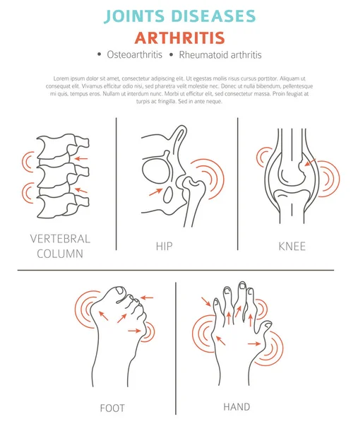 Enfermedades Articulares Síntomas Artritis Conjunto Iconos Tratamiento Diseño Infografía Médica — Archivo Imágenes Vectoriales