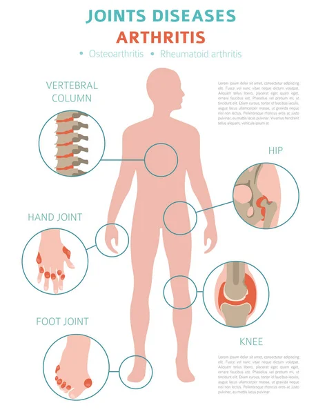 Articula Doenças Sintomas Artrite Conjunto Ícones Tratamento Projeto Infográfico Médico — Vetor de Stock