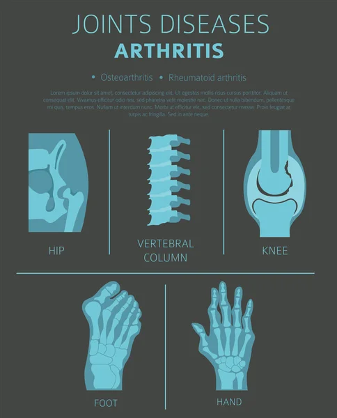 Enfermedades Articulares Síntomas Artritis Conjunto Iconos Tratamiento Diseño Infografía Médica — Vector de stock