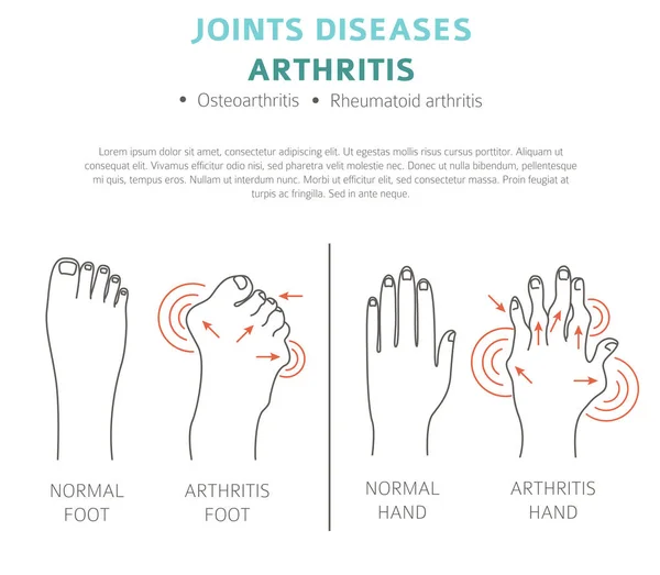 Gelenkerkrankungen Arthritis Symptome Behandlungssymbole Gesetzt Medizinische Infografik Gestaltung Vektorillustration — Stockvektor