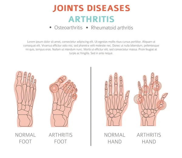 Eklem Hastalıkları Artrit Belirtileri Tedavisi Icon Set Tıbbi Infographic Tasarım — Stok Vektör