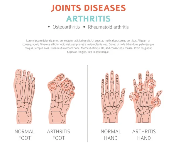 Болезни Суставов Симптомы Артрита Набор Икон Лечения Медицинский Инфографический Дизайн — стоковый вектор
