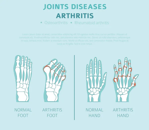 Gelenkerkrankungen Arthritis Symptome Behandlungssymbole Gesetzt Medizinische Infografik Gestaltung Vektorillustration — Stockvektor