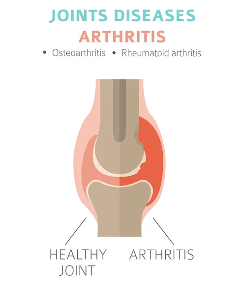 Penyakit Persendian Gejala Artritis Set Ikon Pengobatan Desain Infografis Medis - Stok Vektor
