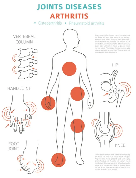 Lederna Sjukdomar Artrit Symptom Behandling Ikonuppsättning Medicinsk Infographic Design Vektorillustration — Stock vektor