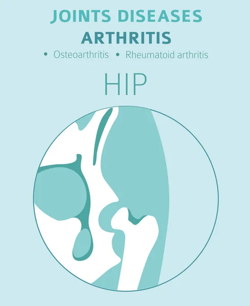 Enfermedades Articulares Síntomas Artritis Conjunto Iconos Tratamiento Diseño Infografía Médica — Vector de stock