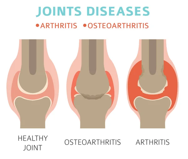 Enfermedades Articulares Artritis Síntomas Osteoartritis Conjunto Iconos Tratamiento Diseño Infografía — Vector de stock