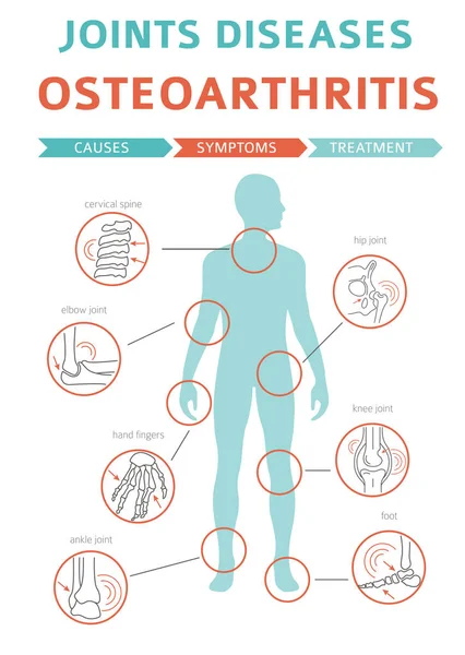 Aandoeningen Van Gewrichten Artritis Artrose Symptomen Behandeling Pictogramserie Medische Infographic — Stockvector