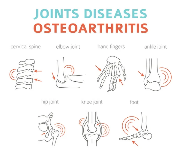 Penyakit Persendian Artritis Gejala Osteoartritis Set Ikon Pengobatan Desain Infografis - Stok Vektor