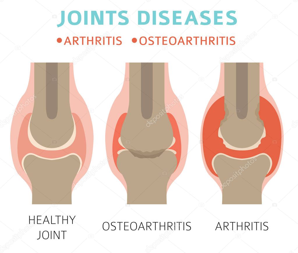 Enfermedades articulares. Artritis, síntomas de osteoartritis, conjunto
