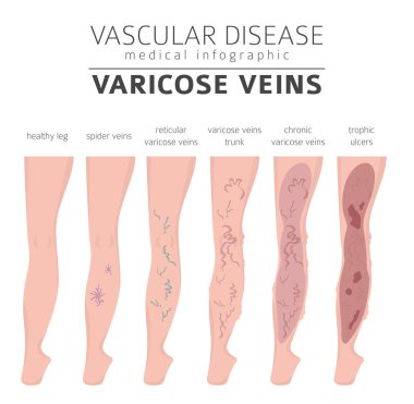 Vasküler hastalıklar. Varis belirtileri, tedavisi Icon set. Tıbbi Infographic tasarım. Vektör çizim