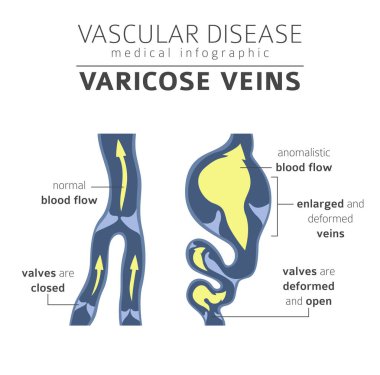 Vasküler hastalıklar. Varis belirtileri, tedavisi Icon set. Tıbbi Infographic tasarım. Vektör çizim
