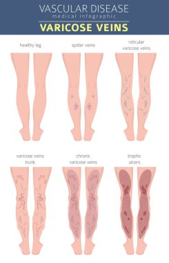 Vasküler hastalıklar. Varis belirtileri, tedavisi Icon set. Tıbbi Infographic tasarım. Vektör çizim