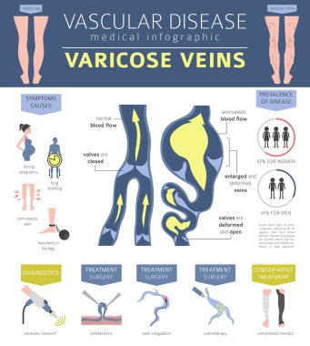 Vasküler hastalıklar. Varis belirtileri, tedavisi Icon set. Tıbbi Infographic tasarım. Vektör çizim