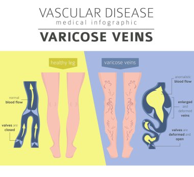 Vasküler hastalıklar. Varis belirtileri, tedavisi Icon set. Tıbbi Infographic tasarım. Vektör çizim