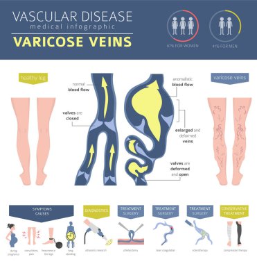Vasküler hastalıklar. Varis belirtileri, tedavisi Icon set. Tıbbi Infographic tasarım. Vektör çizim