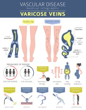 Vasküler hastalıklar. Varis belirtileri, tedavisi Icon set. Tıbbi Infographic tasarım. Vektör çizim