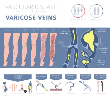 Vasküler hastalıklar. Varis belirtileri, tedavisi Icon set. Tıbbi Infographic tasarım. Vektör çizim