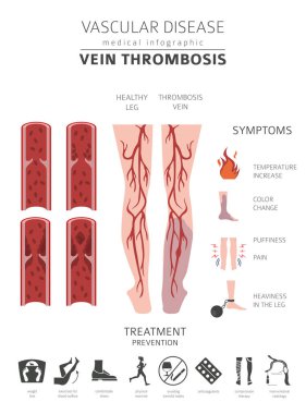 Vasküler hastalıklar. Ven trombozu belirtiler, tedavi simgesi ayarla. Tıbbi Infographic tasarım. Vektör çizim