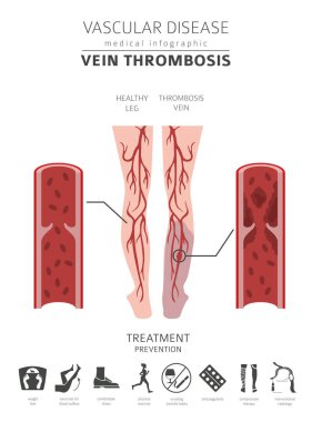 Vasküler hastalıklar. Ven trombozu belirtiler, tedavi simgesi ayarla. Tıbbi Infographic tasarım. Vektör çizim