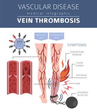 Vasküler hastalıklar. Ven trombozu belirtiler, tedavi simgesi ayarla. Tıbbi Infographic tasarım. Vektör çizim
