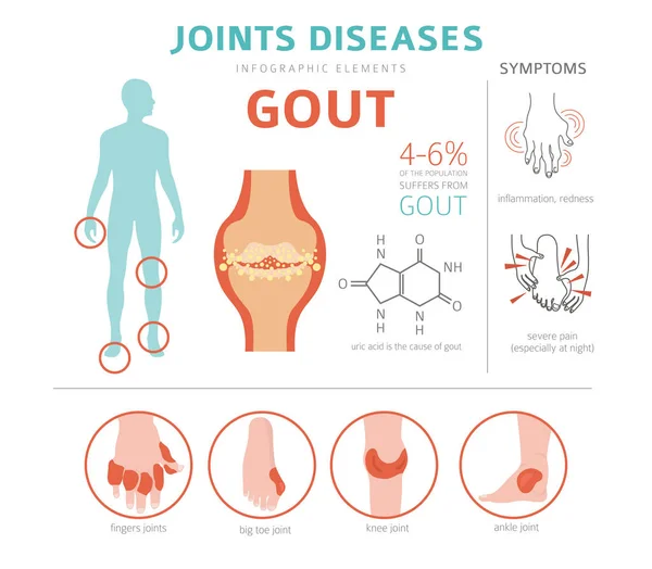 Lederna Sjukdomar Gikt Symtom Behandling Ikonuppsättning Medicinsk Infographic Design Vektorillustration — Stock vektor