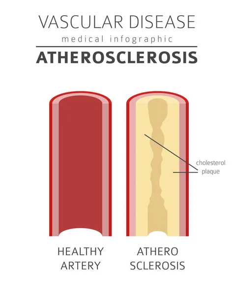 Vasculaire Ziekten Atherosclerose Symptomen Behandeling Pictogramserie Medische Infographic Ontwerp Vectorillustratie — Stockvector