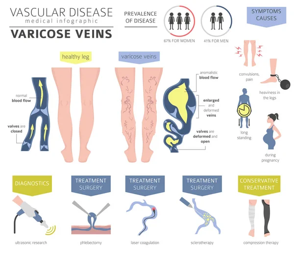 Vasküler hastalıklar. Varis belirtileri, tedavisi Icon set. Tıbbi Infographic tasarım. Vektör çizim