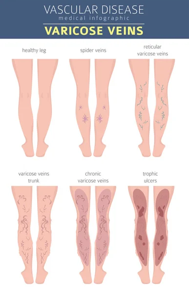 Doenças Vasculares Sintomas Varizes Conjunto Ícones Tratamento Projeto Infográfico Médico — Vetor de Stock