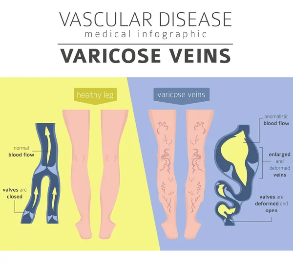 Doenças Vasculares Sintomas Varizes Conjunto Ícones Tratamento Projeto Infográfico Médico — Vetor de Stock