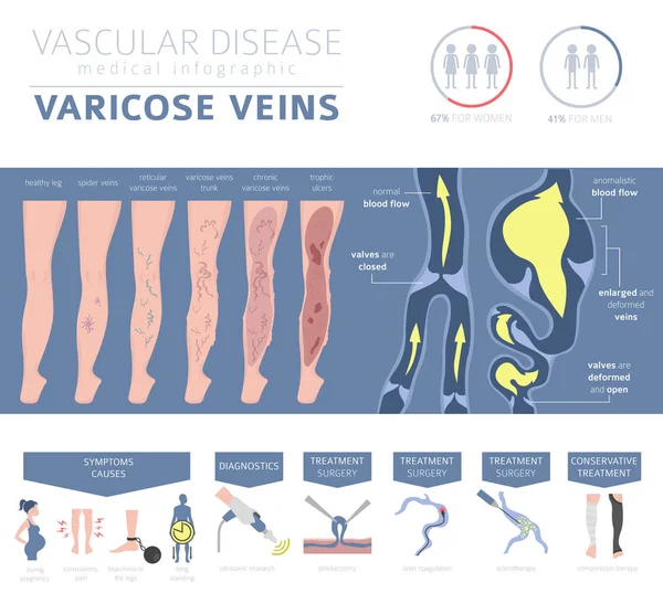 Vascular Diseases Varicose Veins Symptoms Treatment Icon Set Medical Infographic — Stock Vector