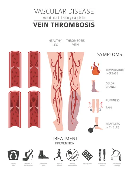 Enfermedades Vasculares Síntomas Trombosis Venosa Conjunto Iconos Tratamiento Diseño Infografía — Vector de stock