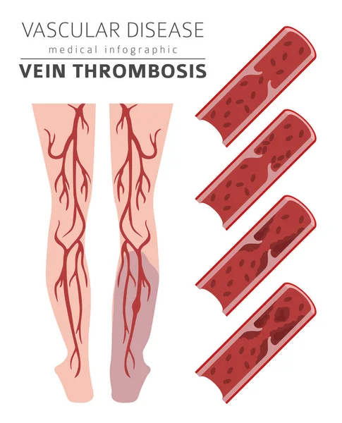 Vasküler hastalıklar. Ven trombozu belirtiler, tedavi Icon set.