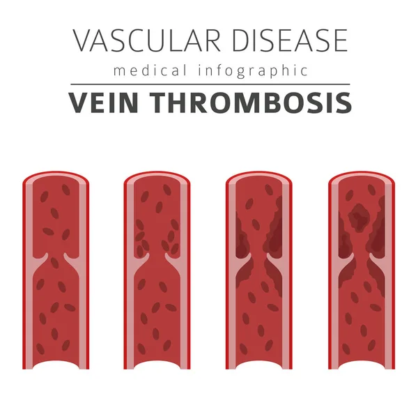 Enfermedades Vasculares Síntomas Trombosis Venosa Conjunto Iconos Tratamiento Diseño Infografía — Vector de stock