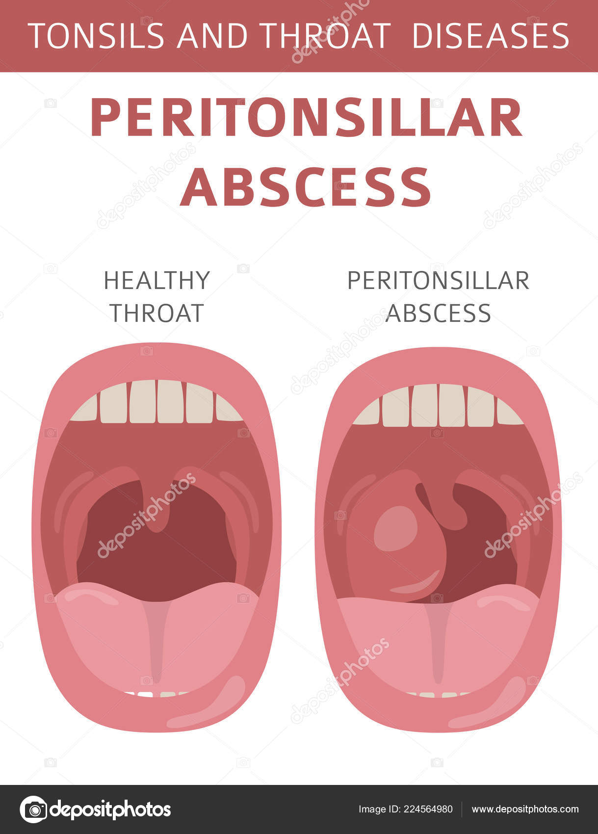 Заболело горло потом кашель. Катаральный ларингит этиология. Заболело горло потом кашель. Причины острого ларингита у детей. Заболевания органов дыхания трахеит.