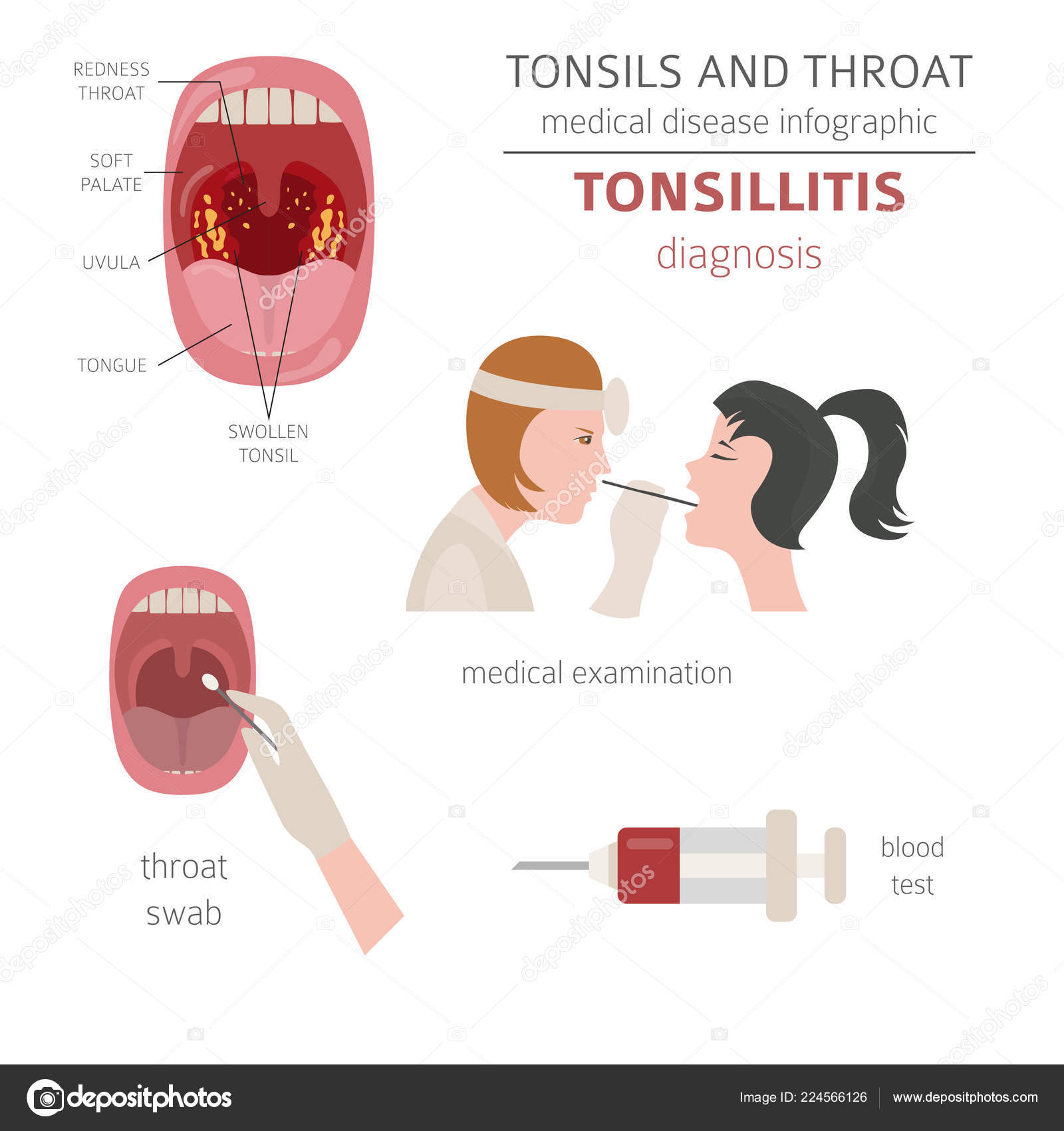 Tonsil Stones Diagram