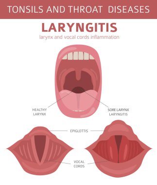 Bademcik ve boğaz hastalıkları. Larenjit belirtiler, tedavi Icon set. Tıbbi Infographic tasarım. Vektör çizim