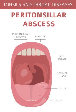 Bademcik ve boğaz hastalıkları. Peritonsiller apse belirtiler, tedavi Icon set. Tıbbi Infographic tasarım. Vektör çizim