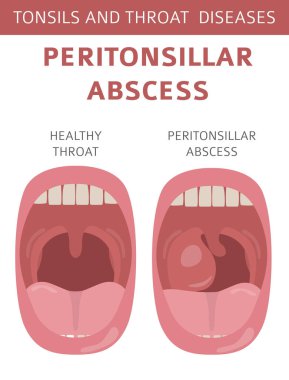 Tonsils and throat diseases. Peritonsillar abscess symptoms, treatment icon set. Medical infographic design. Vector illustration clipart