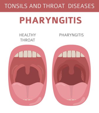 Tonsils and throat diseases. Pharyngitis symptoms, treatment icon set. Medical infographic design. Vector illustration clipart