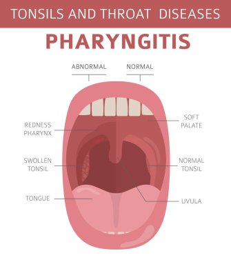 Tonsils and throat diseases. Pharyngitis symptoms, treatment icon set. Medical infographic design. Vector illustration clipart