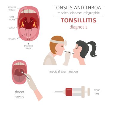 Tonsils and throat diseases. Tonsillitis symptoms, treatment icon set. Medical infographic design. Vector illustration clipart