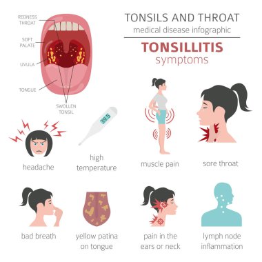 Tonsils and throat diseases. Tonsillitis symptoms, treatment icon set. Medical infographic design. Vector illustration clipart