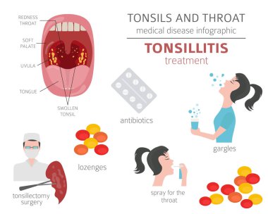 Tonsils and throat diseases. Tonsillitis symptoms, treatment icon set. Medical infographic design. Vector illustration clipart